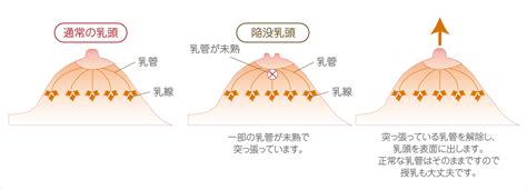 陥没乳首 感じる|見た目だけじゃない！陥没乳頭の問題と治療について – いしゃまち